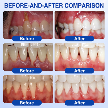 🇺🇸Pureluxo® 🦷GumRevive periodontal repair gel🔥