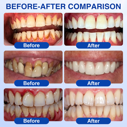 🇺🇸Pureluxo® 🦷GumRevive periodontal repair gel🔥
