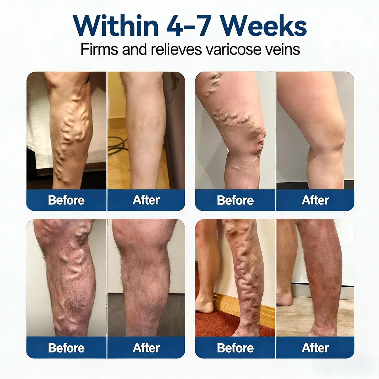 𝐏𝐮𝐫𝐞𝐥𝐮𝐱𝐨® 𝗩𝗲𝒊𝒏 𝐂𝒐𝒏𝘁𝗼𝐮𝐫 𝐌𝐢𝐜𝐫𝐨𝒏𝒆𝒆𝒅𝗹𝗲 𝑷𝒂𝒕𝐜𝐡 (𝐉𝐮𝐬𝐭 𝐎𝐧𝐜𝐞 𝐀 𝐃𝐚𝐲, 𝐒𝐞𝐞 𝐑𝐞𝐬𝐮𝐥𝐭𝐬 𝐈𝐧 𝟕 𝐃𝐚𝐲𝐬) — 👩‍⚕️🏆 𝐒𝐮𝐢𝐭𝐚𝐛𝐥𝐞 𝐅𝐨𝐫 𝐕𝐚𝐫𝐢𝐜𝐨𝐬𝐞 𝐕𝐞𝐢𝐧𝐬 𝐀𝐧𝐝 𝐒𝐩𝐢𝐝𝐞𝐫 𝐕𝐞𝐢𝐧𝐬, 𝐑𝐞𝐥𝐢𝐞𝐯𝐞𝐬 𝐇𝐞𝐚𝐯𝐲, 𝐓𝐢𝐫𝐞𝐝 𝐋𝐞𝐠🛒